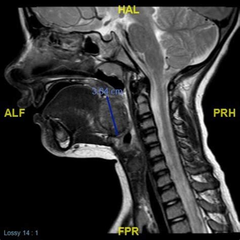 Lingual Thyroid Ectopic Gland In The Tongue Base Archives Of Disease