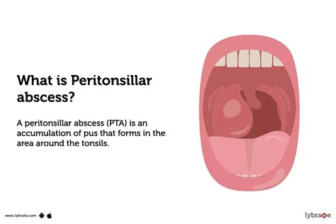Peritonsillar Abscess Causes Symptoms Treatment And Cost