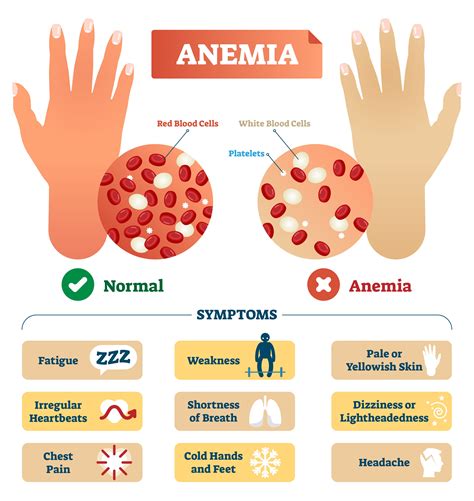 Anemia Symptoms Skin