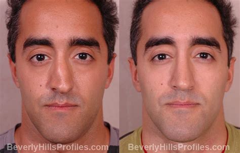 Find before and after pictures of male plastic surgeries done by dr. Before & After Male Rhinoplasty Pictures In Los Angeles