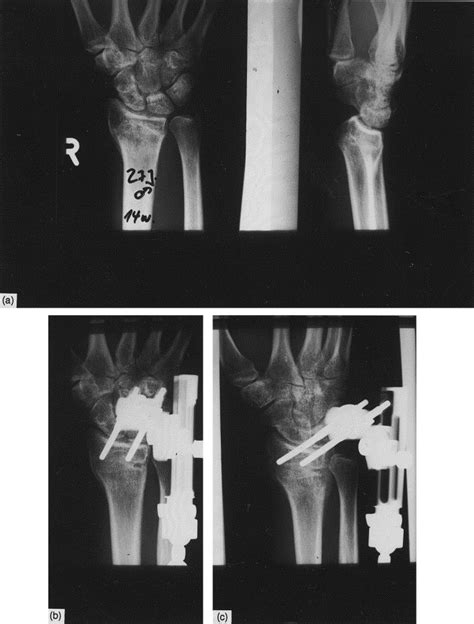 Corrective Osteotomies In Malunited Distal Radius Fractures External