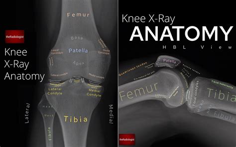Labeled Knee X Ray Anatomy By Dr Naveen Sharma Grepmed Porn Sex Picture