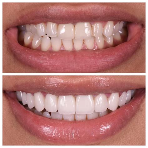 How To Get Perfect Teeth Shape Naturally Unugtp News
