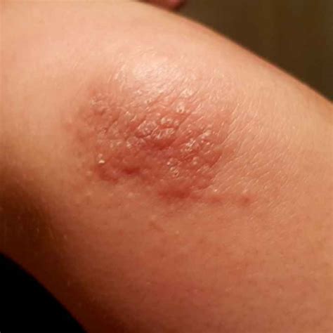 Look Like Dh Bilateral Itchy Bumpy Elbows Dermatitis Herpetiformis
