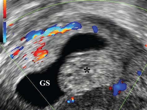 Ultrasound Diagnosis Of Endometrial Polyps In Pregnancy Memtsa 2018