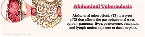 Stomach Intestinal Abdominal Tuberculosis Causes Symptoms
