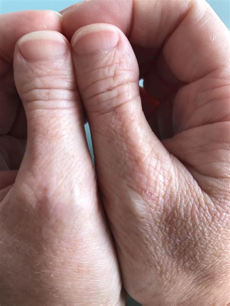 Get Clubbed Thumb Acrylic Nails Images