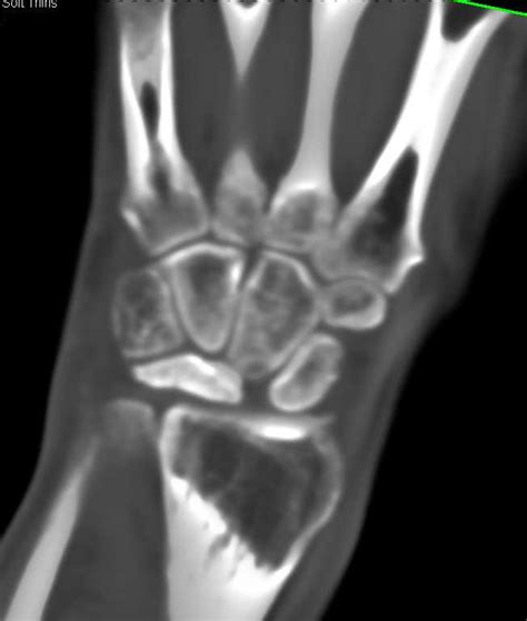 Fracture With Avascular Necrosis Avn Lunate Musculoskeletal Case