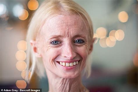 The Woman Who Ages Eight Times Faster Than Normal 41 Year Old Has Rare