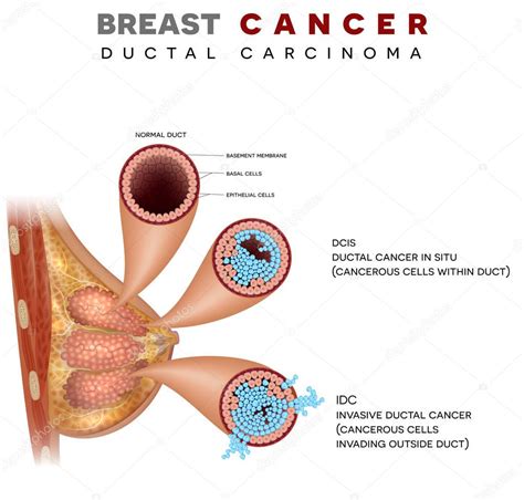 Ilustración de anatomía del cáncer de mama Carcinoma ductal de mama