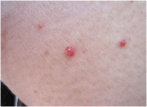 Pinpoint Red Dots On Skin Cancer Gnomgun