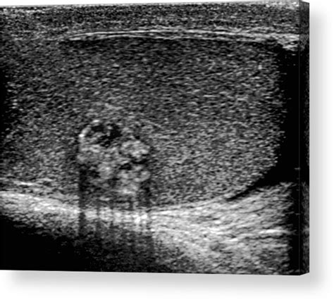 Testicular Cancer Ultrasound Scan Acrylic Print By Du Cane Medical Hot Sex Picture