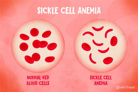 Medical Cannabis And Sickle Cell Disease What Is The Connection