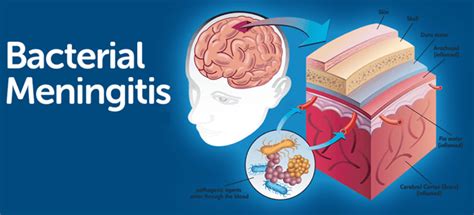 Bacterial Meningitis Causes Symptoms Diagnosis Prevention And Treatment