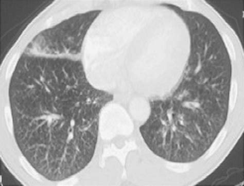 Primary Pulmonary Mucosa Associated Lymphoid Tissue Lymphoma In A