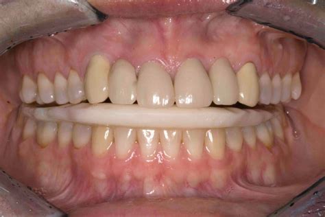 The occlusion is seen as the key for a functional integration of an aesthetic treatment and must be considered whenever anterior aesthetic restorations are to be placed. Fabricating An Anatomic Appliance-Creating The Occlusion ...