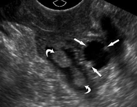 An Intravaginal Sonographic View Of The Left Adnexa Identifies A