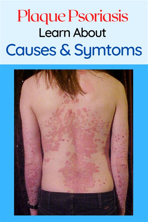 About Plaque Psoriasis Learn About Causes And Symtoms Raindrops To