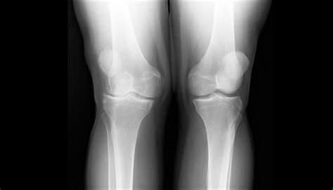Ortho Dx Valgus Deformity Of The Knee Clinical Advisor