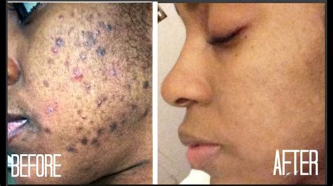 It is possible to get rid of hyperpigmentation, but it will take time. SKIN| How I Got Rid of Dark Scars (Hyperpigmentation ...