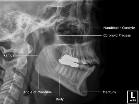 Mandible Radiographic Anatomy Wikiradiography