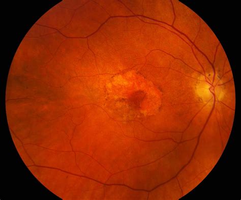 Macular Degeneration Retina Vitreous Associates Medical Group