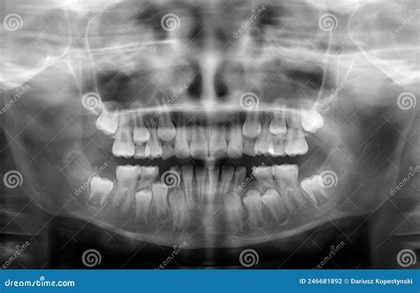 Child Teeth X Ray Stock Photo Image Of Nine Dental 246681892
