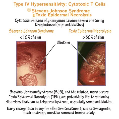 Clinical Pathology Glossary Stevens Johnson Syndrome Toxic Epidermal
