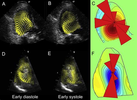 Intracardiac Flow Analysis Techniques And Potential Clinical