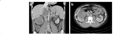Abdominal Ct Scan At The Time Of Diagnosis Right Kidney Tumor With