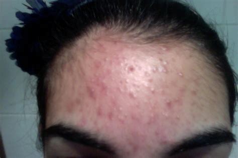 Small Clear Bumps On Forehead General Acne Discussion