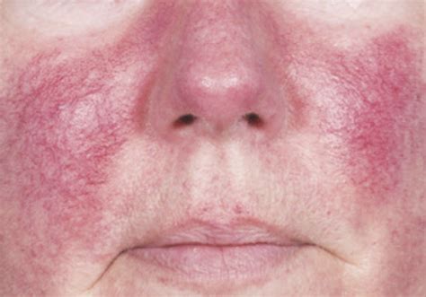 Everything You Need To Know About Rosacea And How To Treat It Lauren Erro
