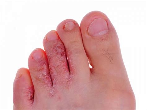 What Are The Different Types Of Foot Fungal Infections Or Onychomycoses