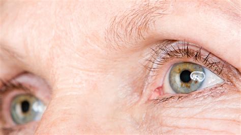 el síndrome del ojo seco centro ocular dr giron