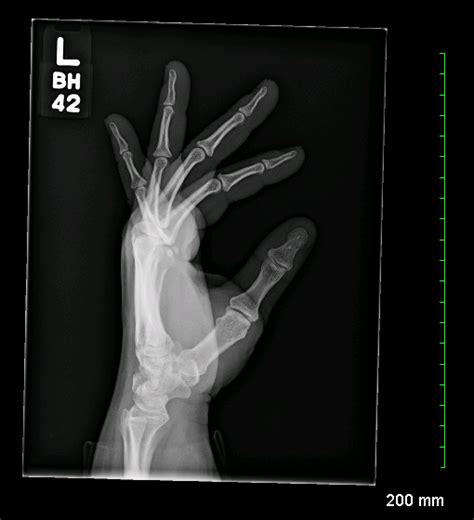 Archive Of Unremarkable Radiological Studies Left Hand X Ray Stepwards