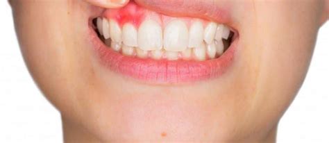 Bleeding Gums Pimpama City Dental Centre