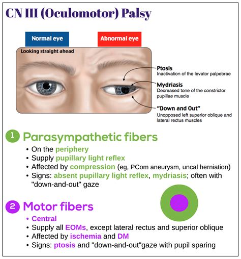 CN III Oculomotor Palsy Medicine Keys For MRCPs