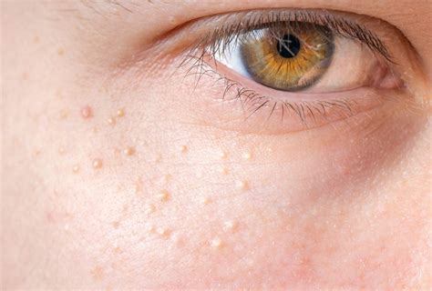 Chicken Skin Under Eyes Causes Home Remedies And Dos And Donts