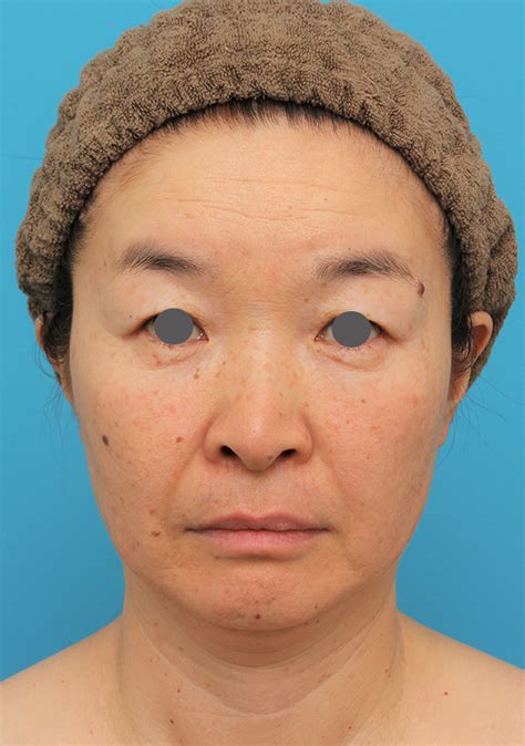 フェイスリフトでたるみをリフトアップさせた50代後半女性の症例写真：美容外科 高須クリニック