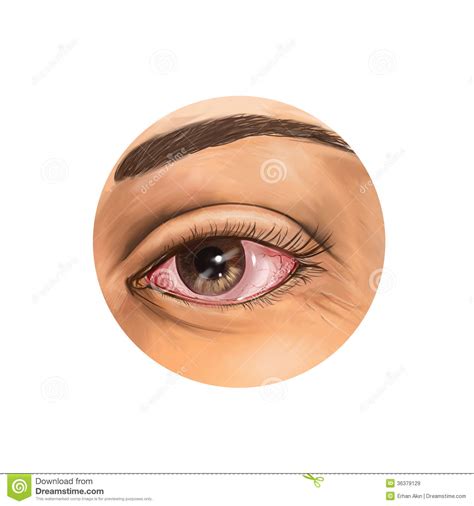 See more ideas about bloodshot eyes, drawings, art inspiration. Bloodshot eye stock image. Image of eyeball, medical ...