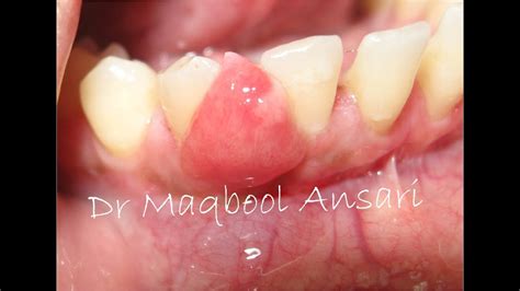 Excision Of Gingival Epulis Youtube