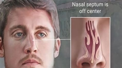 What Is Deviated Septum Surgery Ask The Ent Capital Ent And Sinus Center