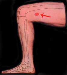 Flank Pain Acupressure Treatment