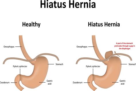 4 Lesser Known Facts About Hiatal Hernia Dr Sachin Kukreja Dallas