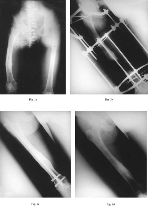 Figure 1 From Application Of Locked Intramedullary Nails In The