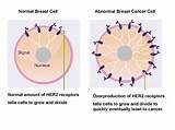 Estrogen Receptor Breast Cancer Treatment Photos