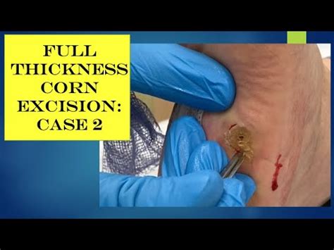 Video Full Thickness Excision Case Youtube