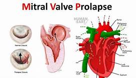 Mitral valve prolapse might guarantee your life, cautions study