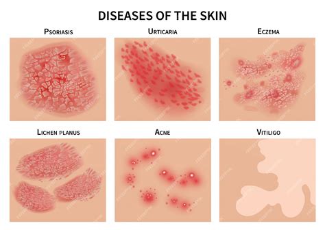 Premium Vector Skin Diseases Derma Infection Eczema And Psoriasis Dermatology Illustration