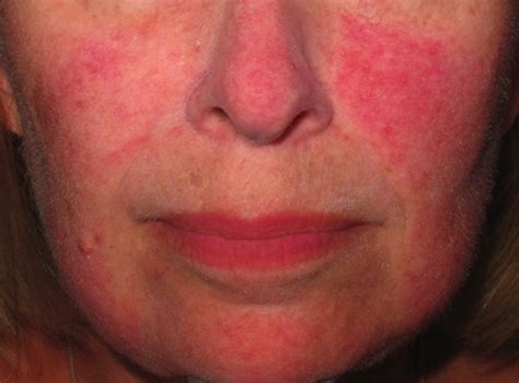 Blotchy Skin Laser Treatments For Redness And Pigmentation Sydney